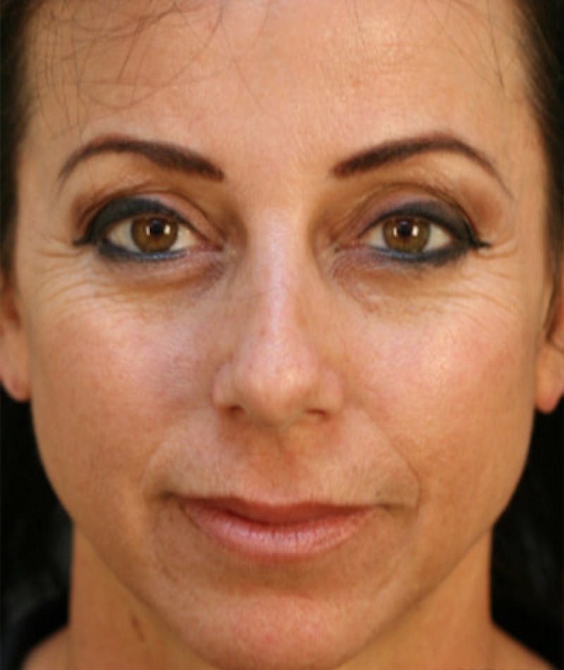 Primary Rhinoplasty Before & After Gallery - Patient 108174324 - Image 3