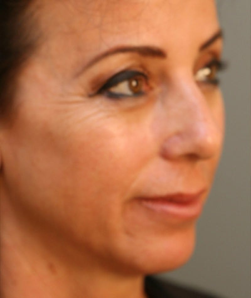 Primary Rhinoplasty Before & After Gallery - Patient 108174324 - Image 5