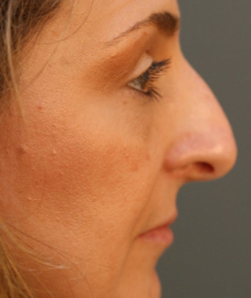 Primary Rhinoplasty Before & After Gallery - Patient 108174326 - Image 1