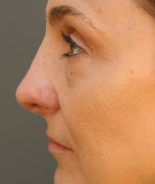 Primary Rhinoplasty Before & After Gallery - Patient 108174326 - Image 2