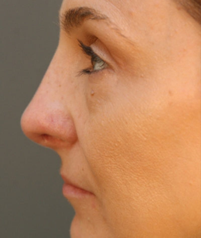 Primary Rhinoplasty Before & After Gallery - Patient 108174326 - Image 2