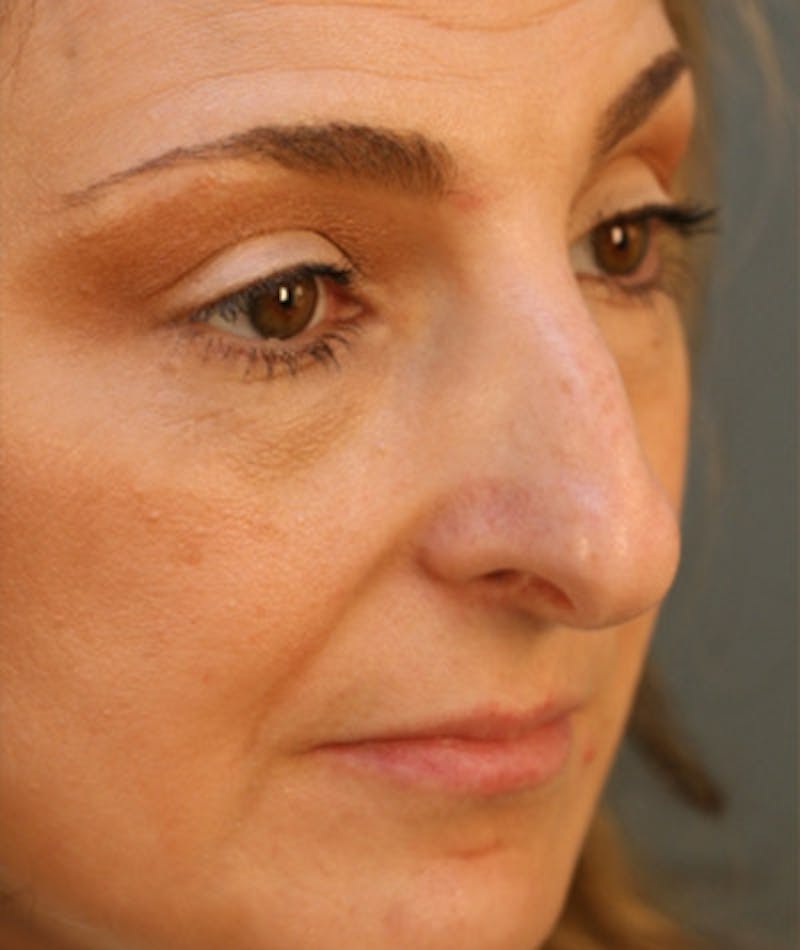 Primary Rhinoplasty Before & After Gallery - Patient 108174326 - Image 3
