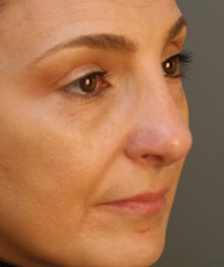 Primary Rhinoplasty Before & After Gallery - Patient 108174326 - Image 4