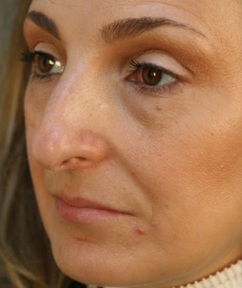Primary Rhinoplasty Before & After Gallery - Patient 108174326 - Image 5