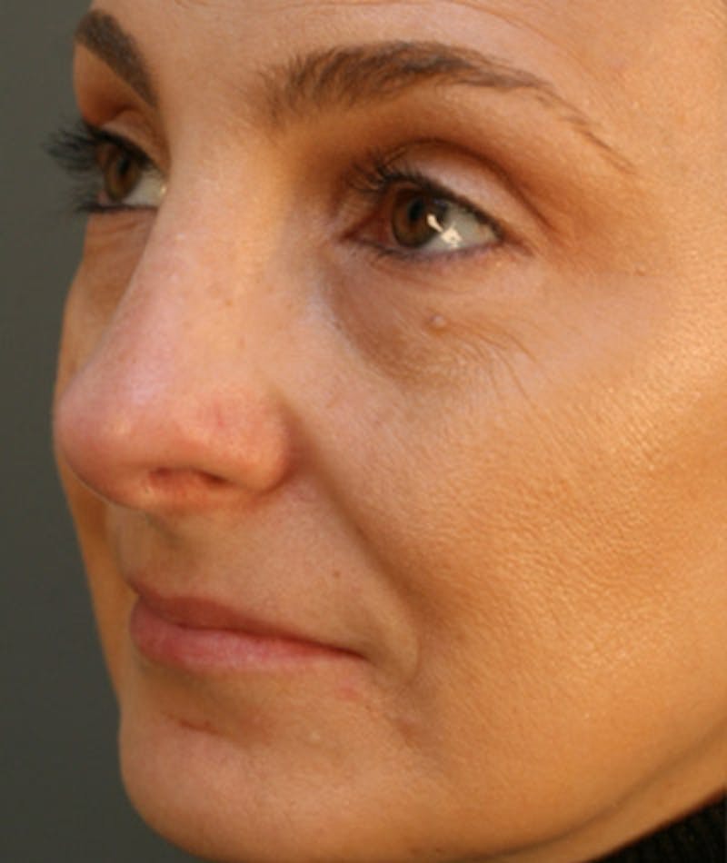 Primary Rhinoplasty Before & After Gallery - Patient 108174326 - Image 6