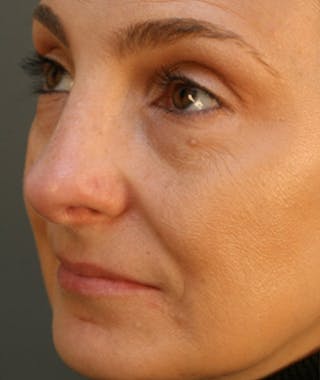 Primary Rhinoplasty Before & After Gallery - Patient 108174326 - Image 6