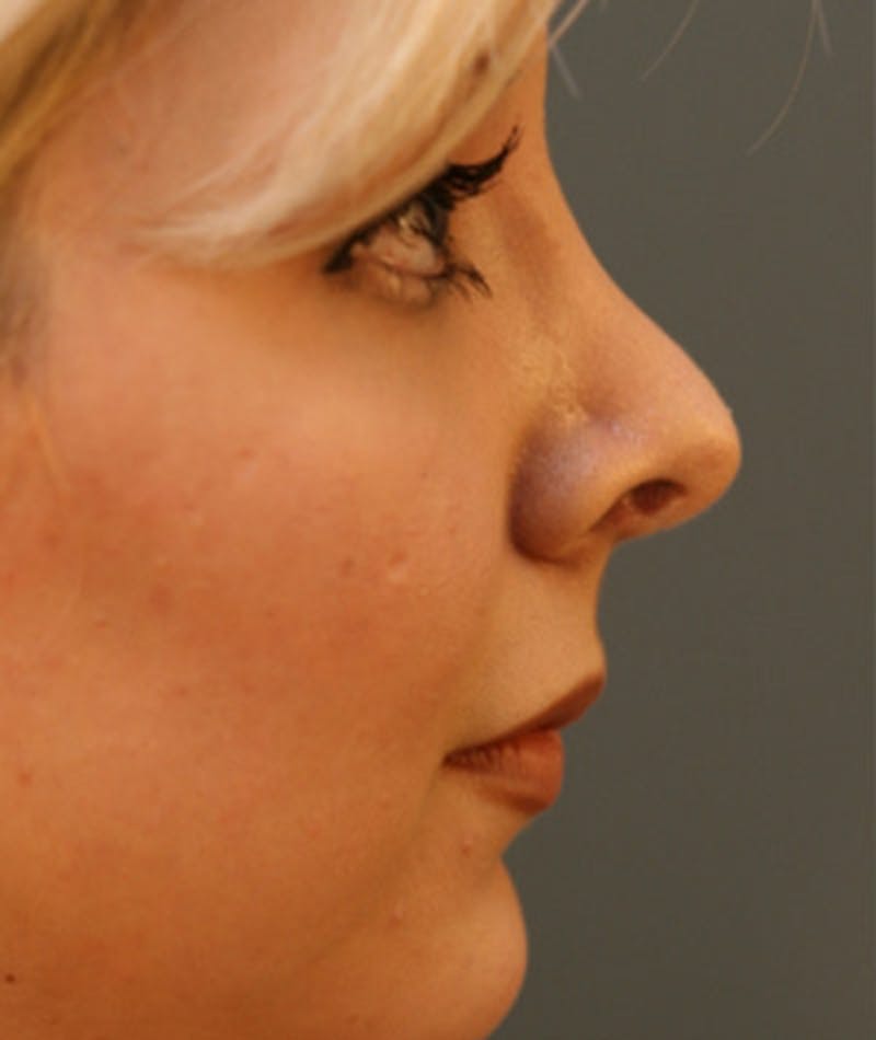 Primary Rhinoplasty Before & After Gallery - Patient 108174327 - Image 1