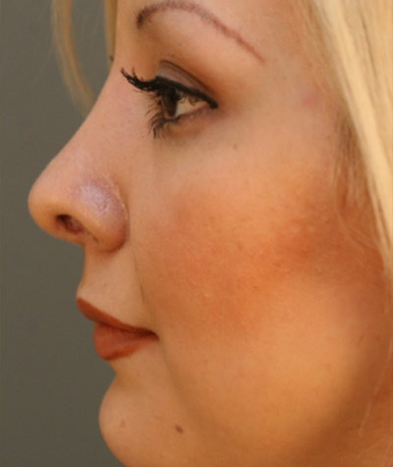Primary Rhinoplasty Before & After Gallery - Patient 108174327 - Image 2
