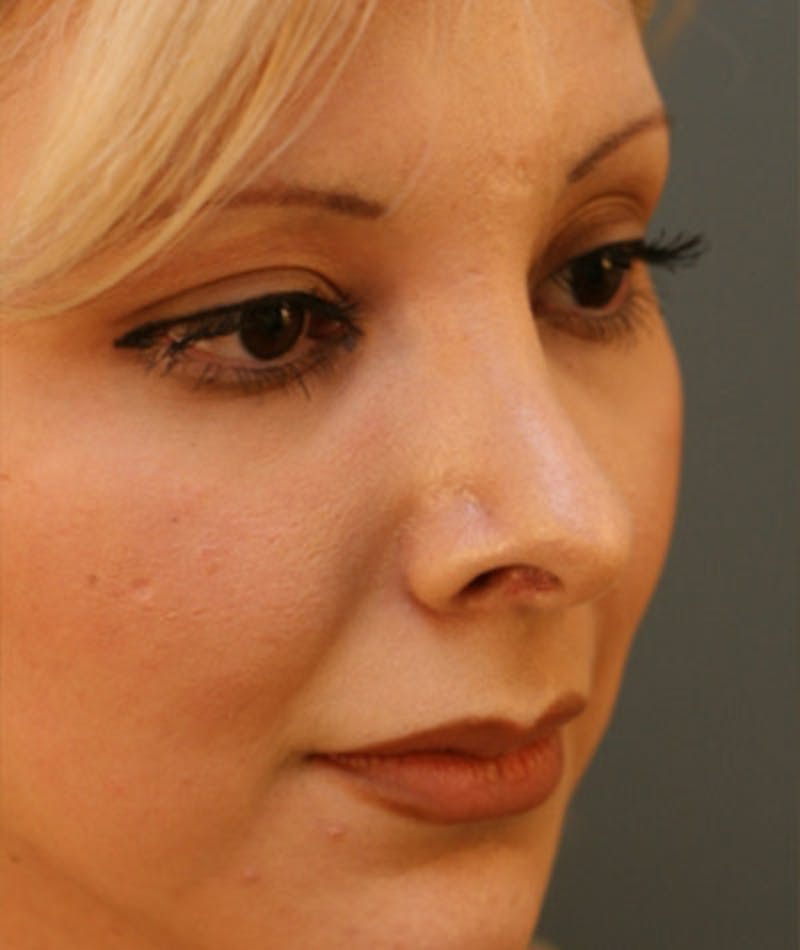 Primary Rhinoplasty Before & After Gallery - Patient 108174327 - Image 5