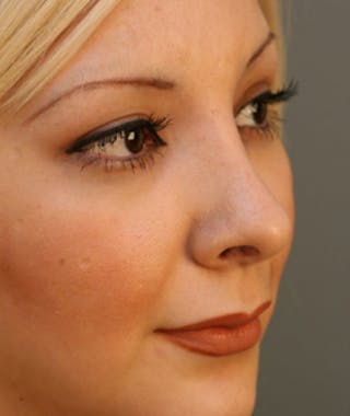 Primary Rhinoplasty Before & After Gallery - Patient 108174327 - Image 6