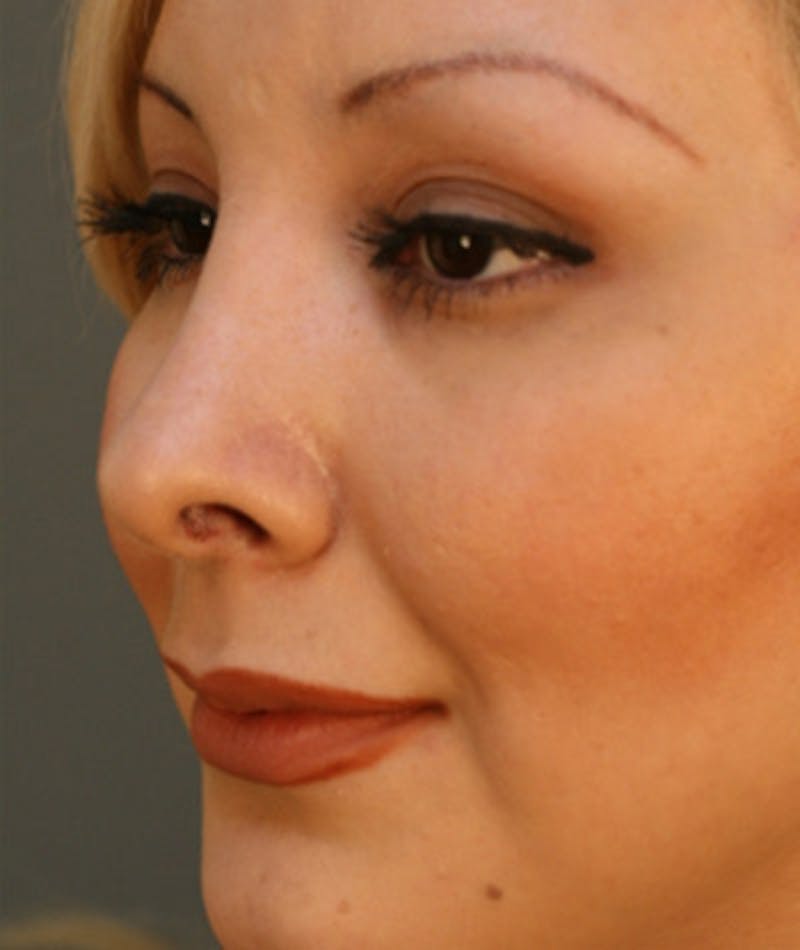 Primary Rhinoplasty Before & After Gallery - Patient 108174327 - Image 8