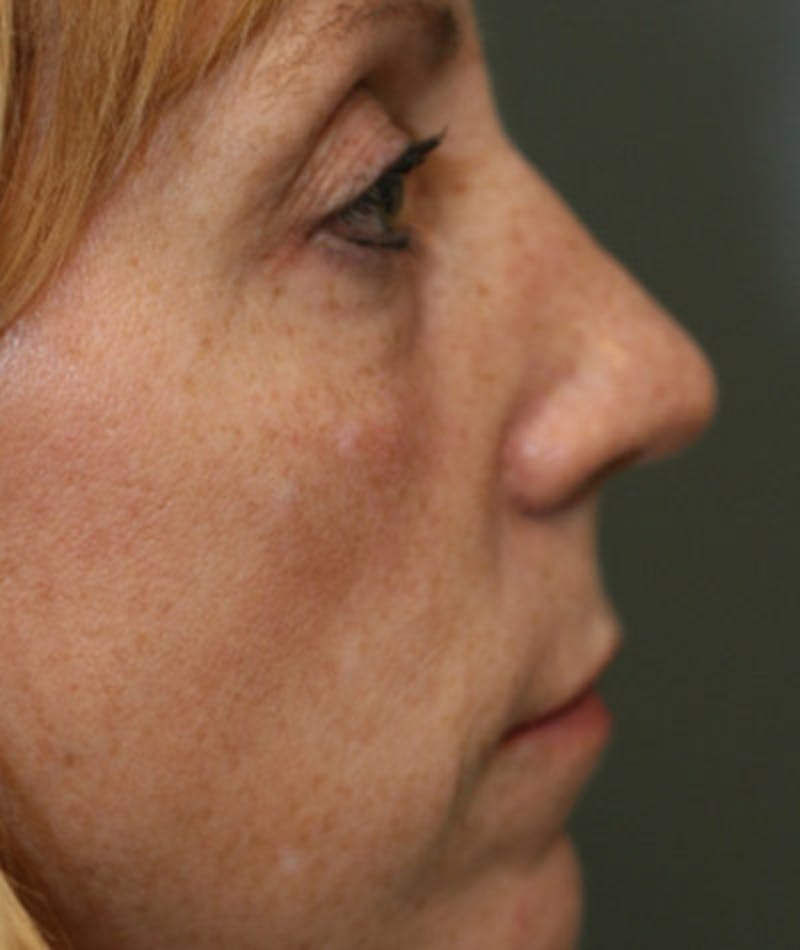 Primary Rhinoplasty Before & After Gallery - Patient 108174328 - Image 1