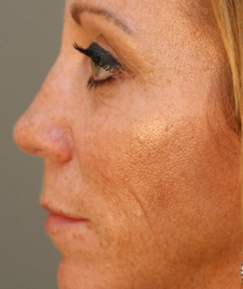 Primary Rhinoplasty Before & After Gallery - Patient 108174328 - Image 2
