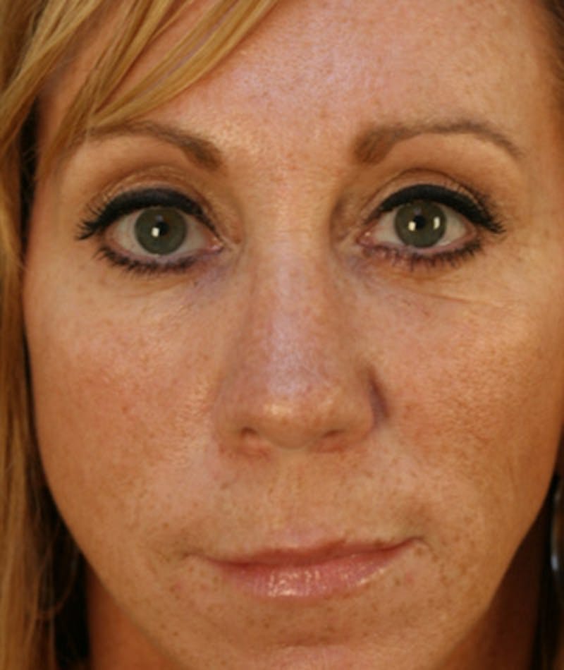Primary Rhinoplasty Before & After Gallery - Patient 108174328 - Image 4