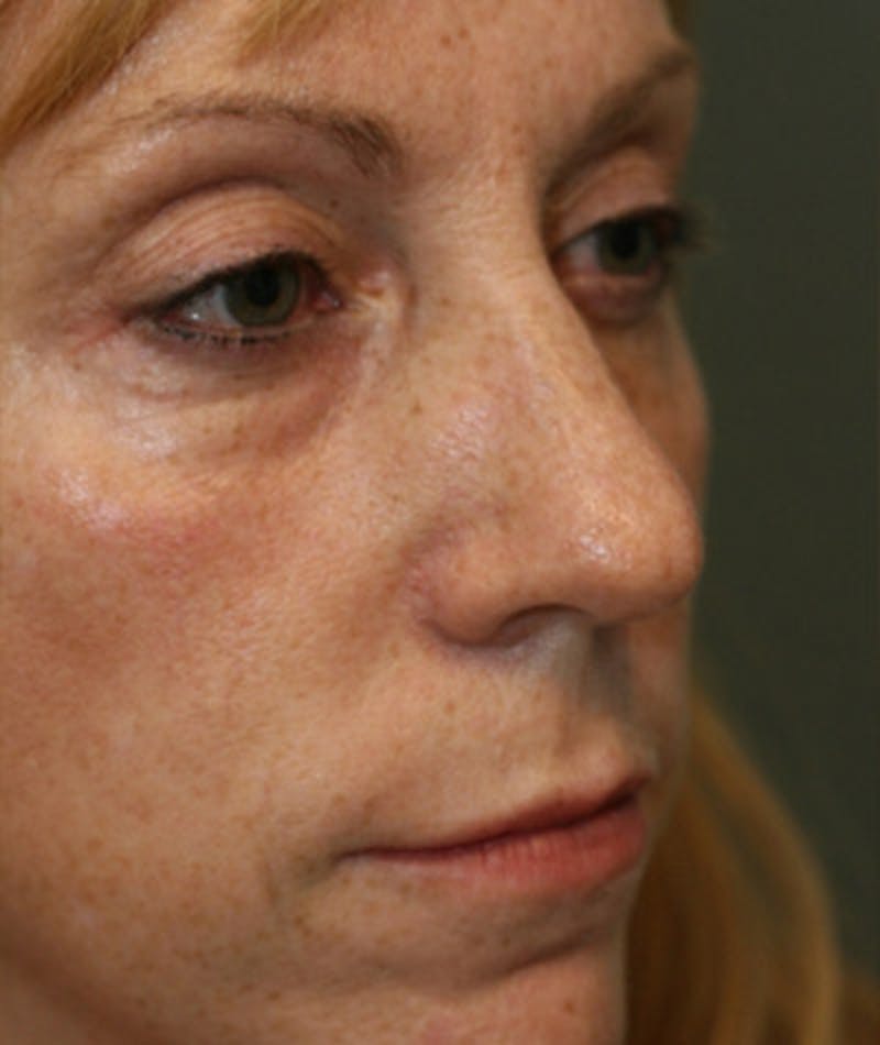 Primary Rhinoplasty Before & After Gallery - Patient 108174328 - Image 5