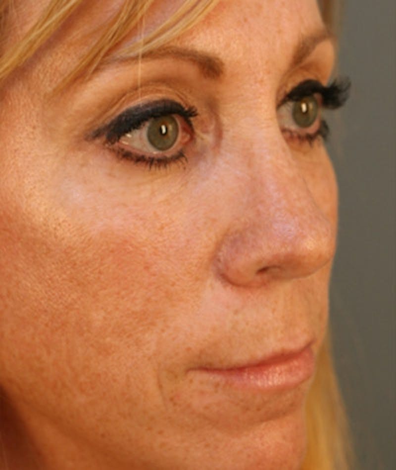 Primary Rhinoplasty Before & After Gallery - Patient 108174328 - Image 6