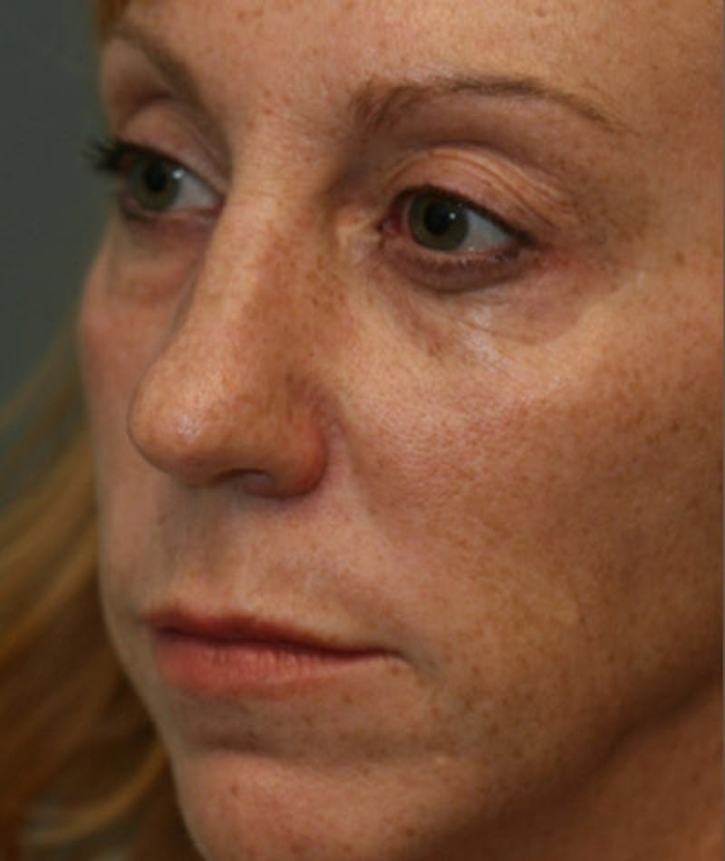 Primary Rhinoplasty Before & After Gallery - Patient 108174328 - Image 7