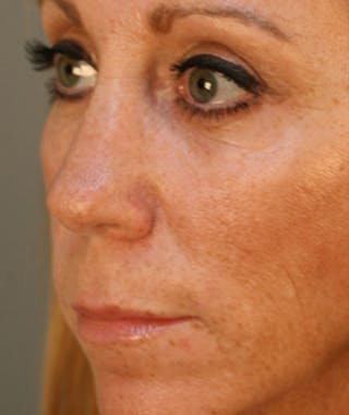 Primary Rhinoplasty Before & After Gallery - Patient 108174328 - Image 8