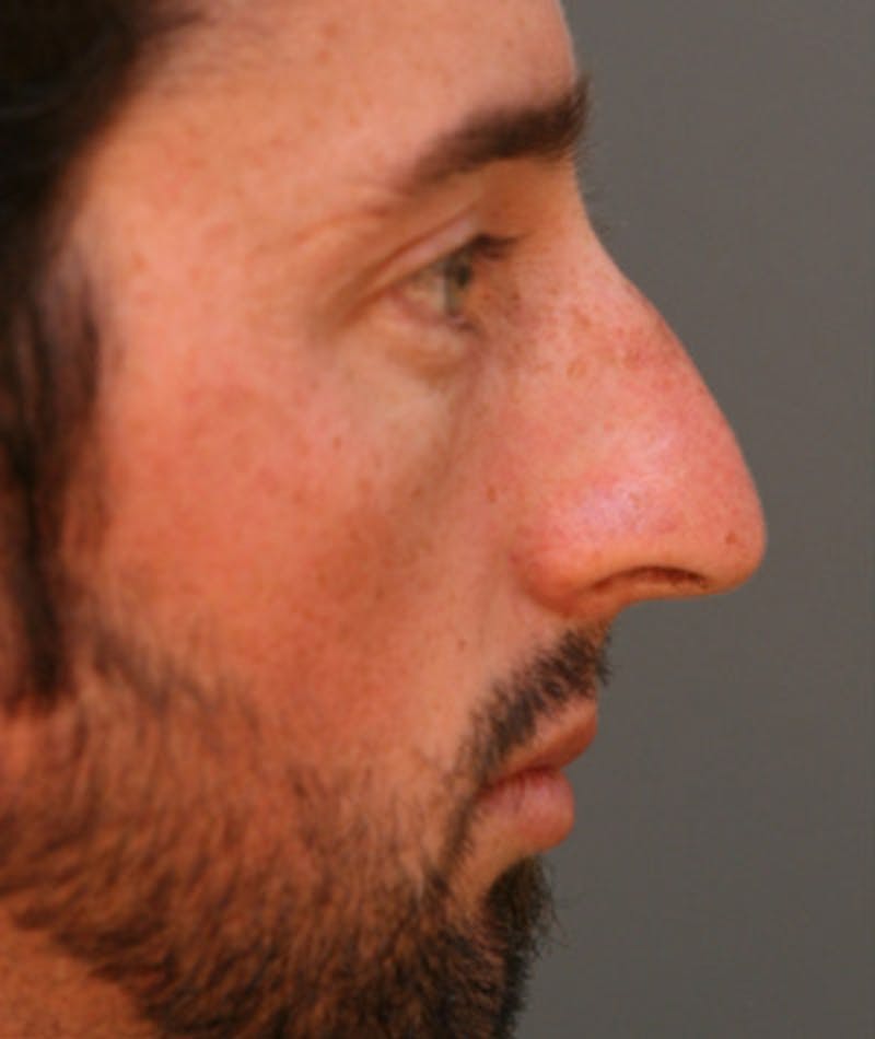Primary Rhinoplasty Before & After Gallery - Patient 108174329 - Image 1