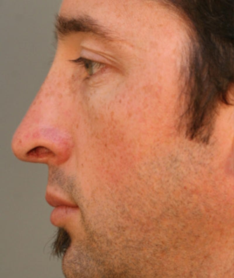 Primary Rhinoplasty Before & After Gallery - Patient 108174329 - Image 2