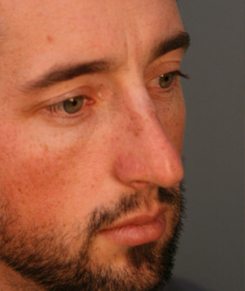 Primary Rhinoplasty Before & After Gallery - Patient 108174329 - Image 3