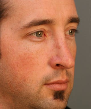 Primary Rhinoplasty Before & After Gallery - Patient 108174329 - Image 4