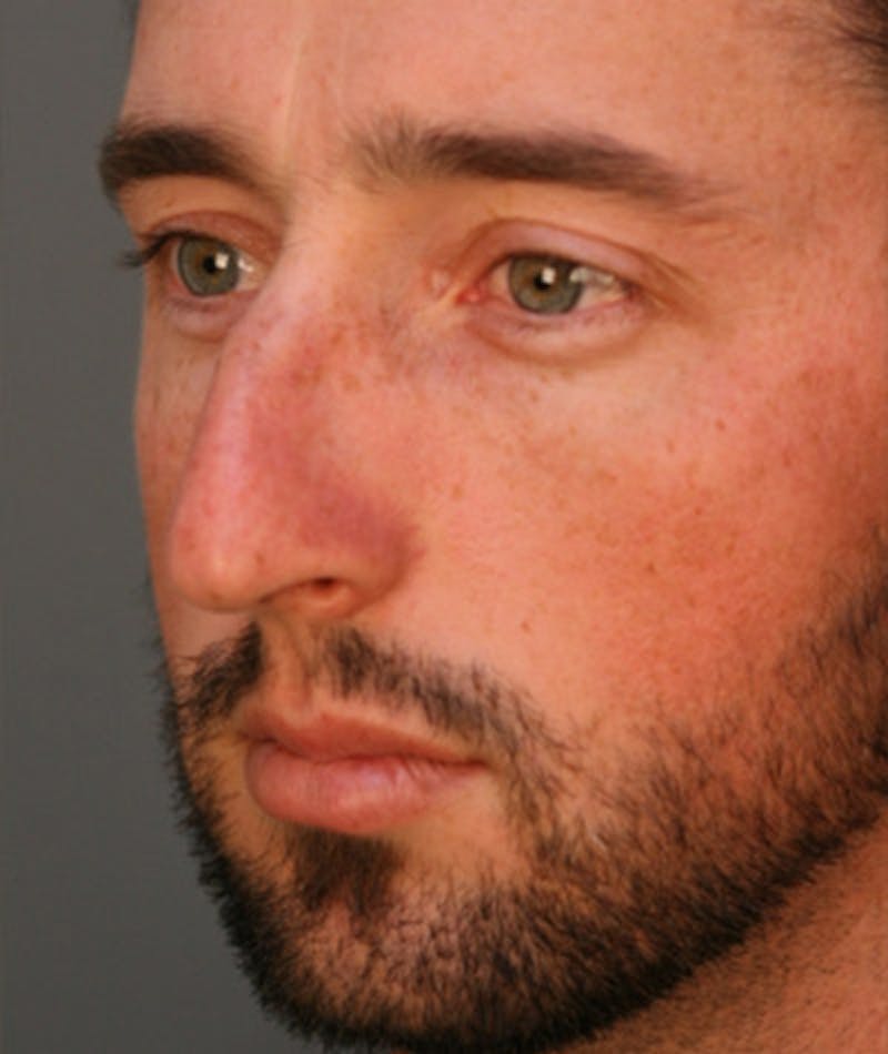 Primary Rhinoplasty Before & After Gallery - Patient 108174329 - Image 5