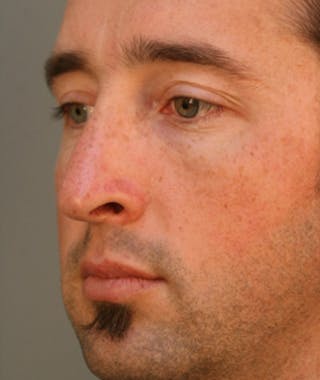 Primary Rhinoplasty Before & After Gallery - Patient 108174329 - Image 6