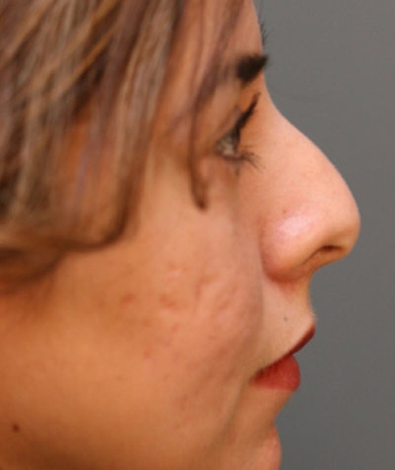 Primary Rhinoplasty Before & After Gallery - Patient 108174330 - Image 1