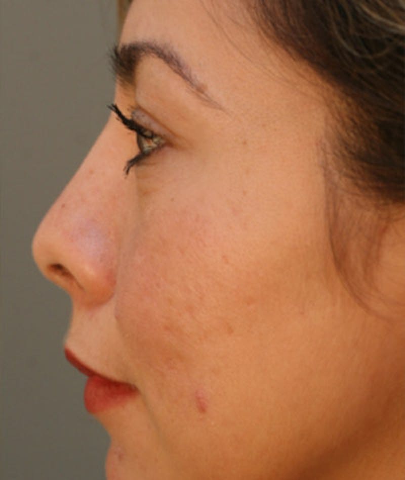 Primary Rhinoplasty Before & After Gallery - Patient 108174330 - Image 2