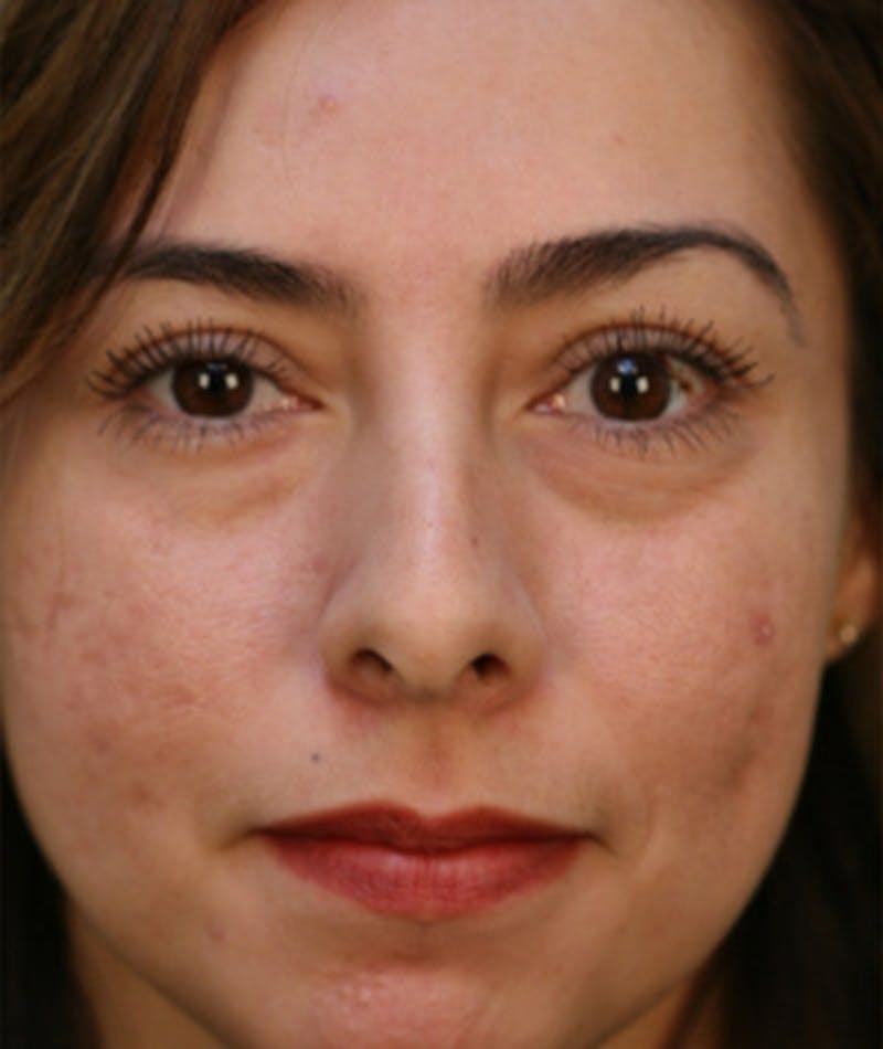 Primary Rhinoplasty Before & After Gallery - Patient 108174330 - Image 3