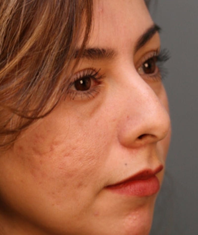 Primary Rhinoplasty Before & After Gallery - Patient 108174330 - Image 5