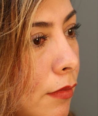 Primary Rhinoplasty Before & After Gallery - Patient 108174330 - Image 6