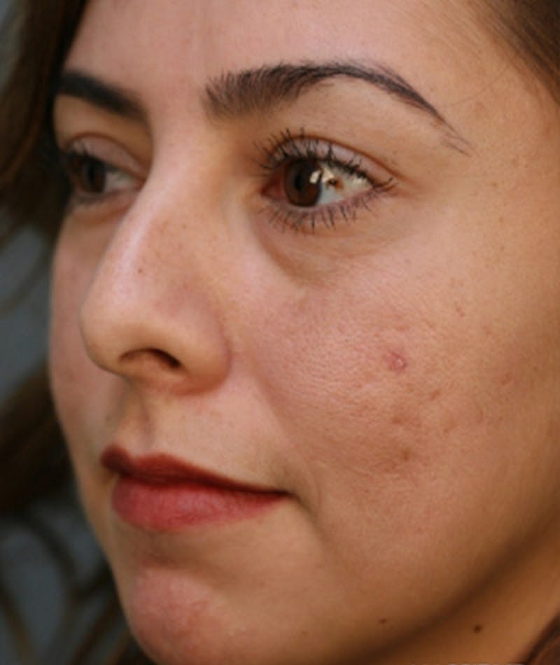 Primary Rhinoplasty Before & After Gallery - Patient 108174330 - Image 7