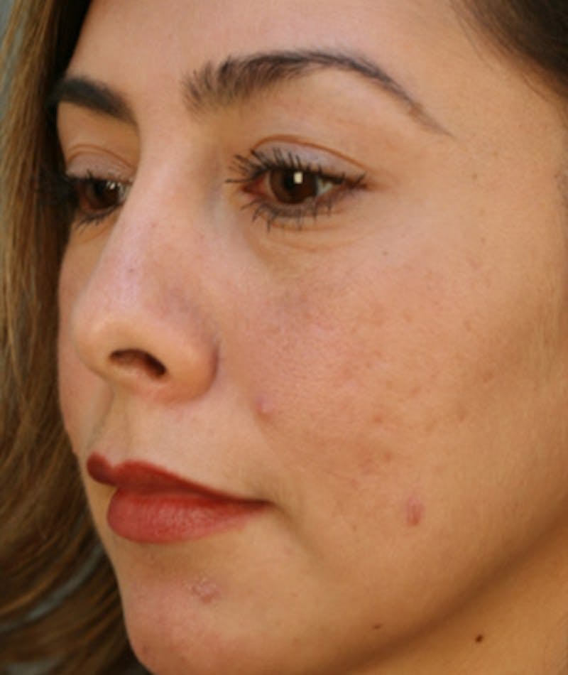 Primary Rhinoplasty Before & After Gallery - Patient 108174330 - Image 8