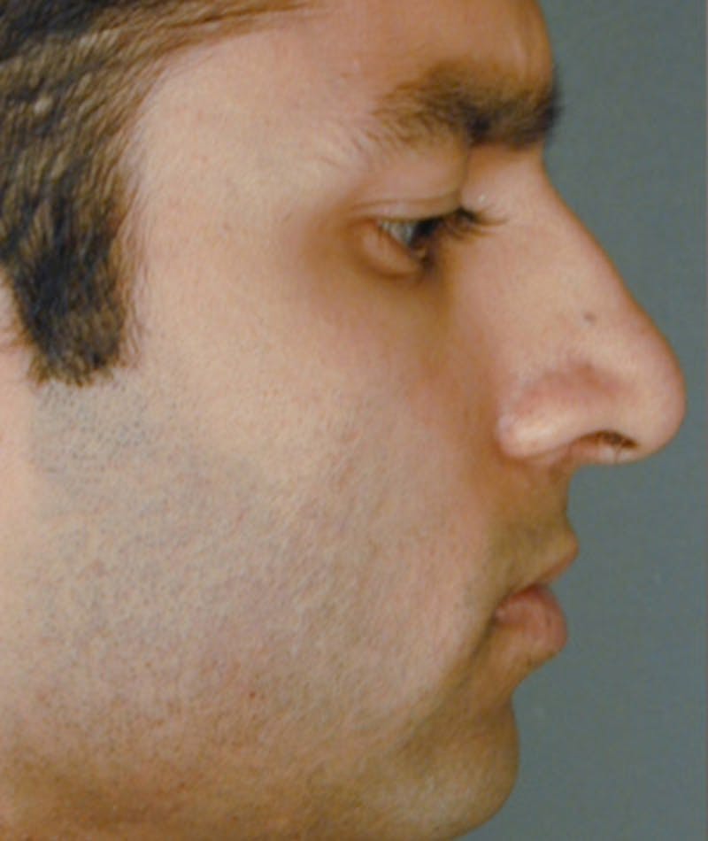 Primary Rhinoplasty Before & After Gallery - Patient 108174331 - Image 1