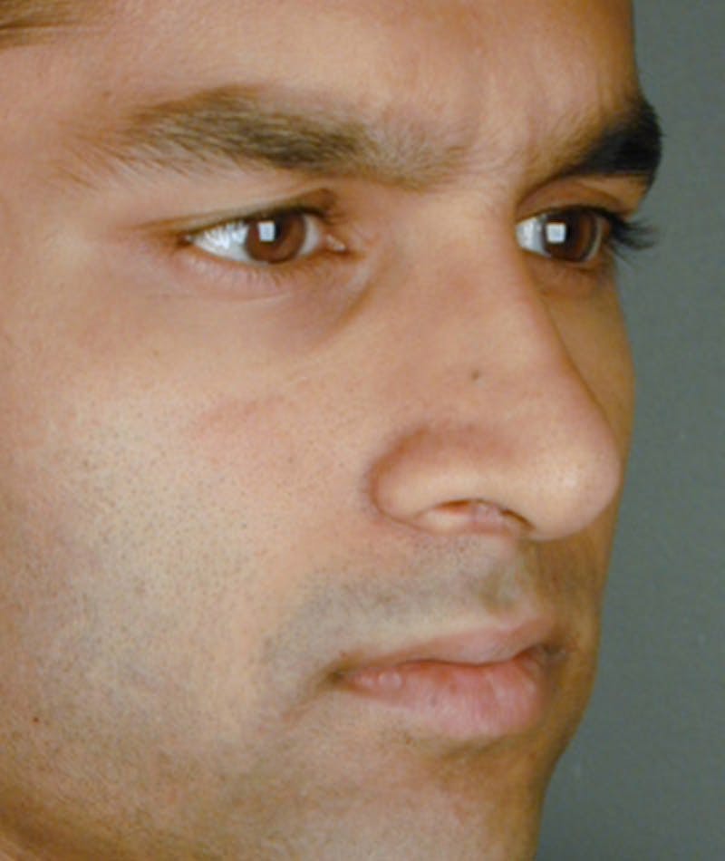 Primary Rhinoplasty Before & After Gallery - Patient 108174331 - Image 5