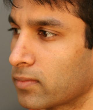 Primary Rhinoplasty Before & After Gallery - Patient 108174331 - Image 8