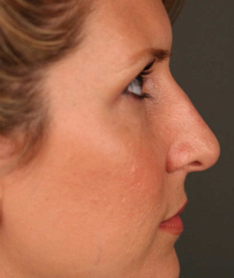 Primary Rhinoplasty Before & After Gallery - Patient 108174332 - Image 1
