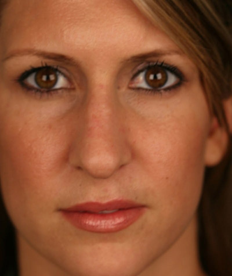 Primary Rhinoplasty Before & After Gallery - Patient 108174332 - Image 3