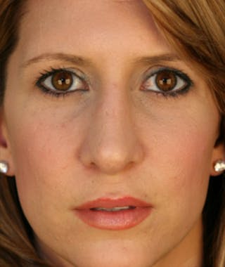 Primary Rhinoplasty Before & After Gallery - Patient 108174332 - Image 4