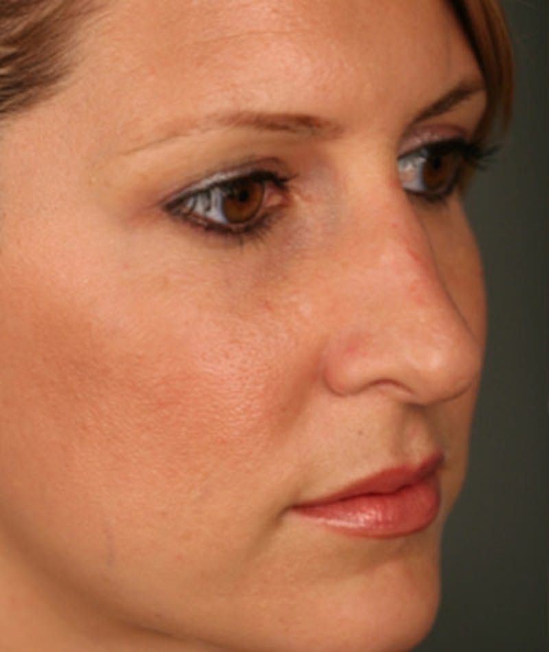 Primary Rhinoplasty Before & After Gallery - Patient 108174332 - Image 5