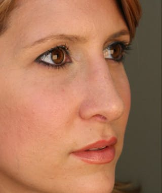 Primary Rhinoplasty Before & After Gallery - Patient 108174332 - Image 6