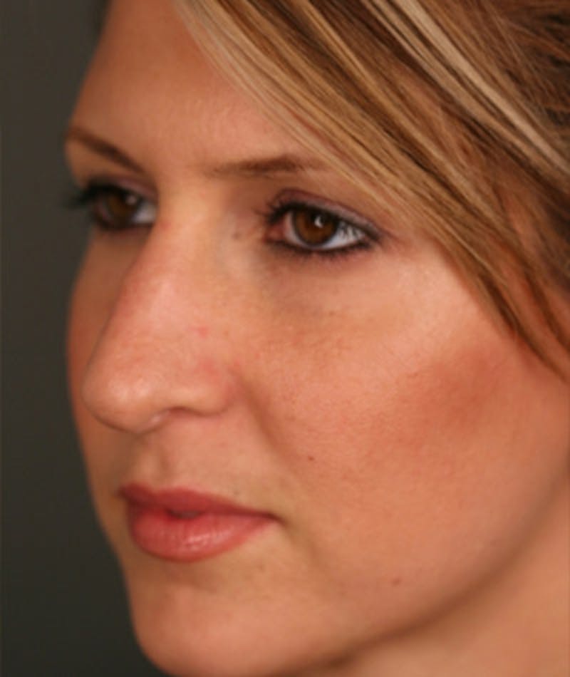 Primary Rhinoplasty Before & After Gallery - Patient 108174332 - Image 7