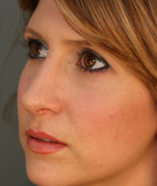 Primary Rhinoplasty Before & After Gallery - Patient 108174332 - Image 8