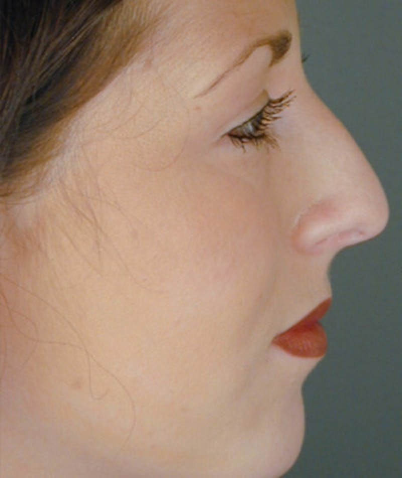 Primary Rhinoplasty Before & After Gallery - Patient 108174333 - Image 1