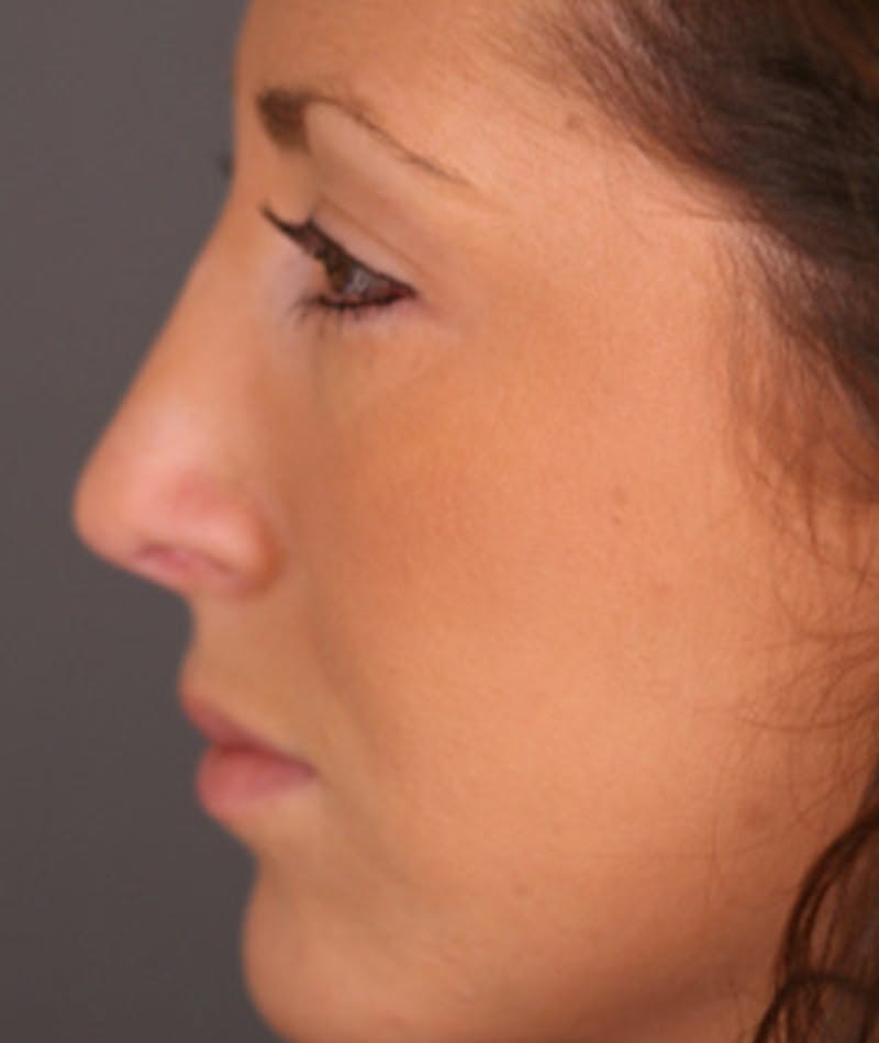 Primary Rhinoplasty Before & After Gallery - Patient 108174333 - Image 2