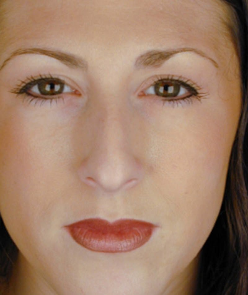 Primary Rhinoplasty Before & After Gallery - Patient 108174333 - Image 3