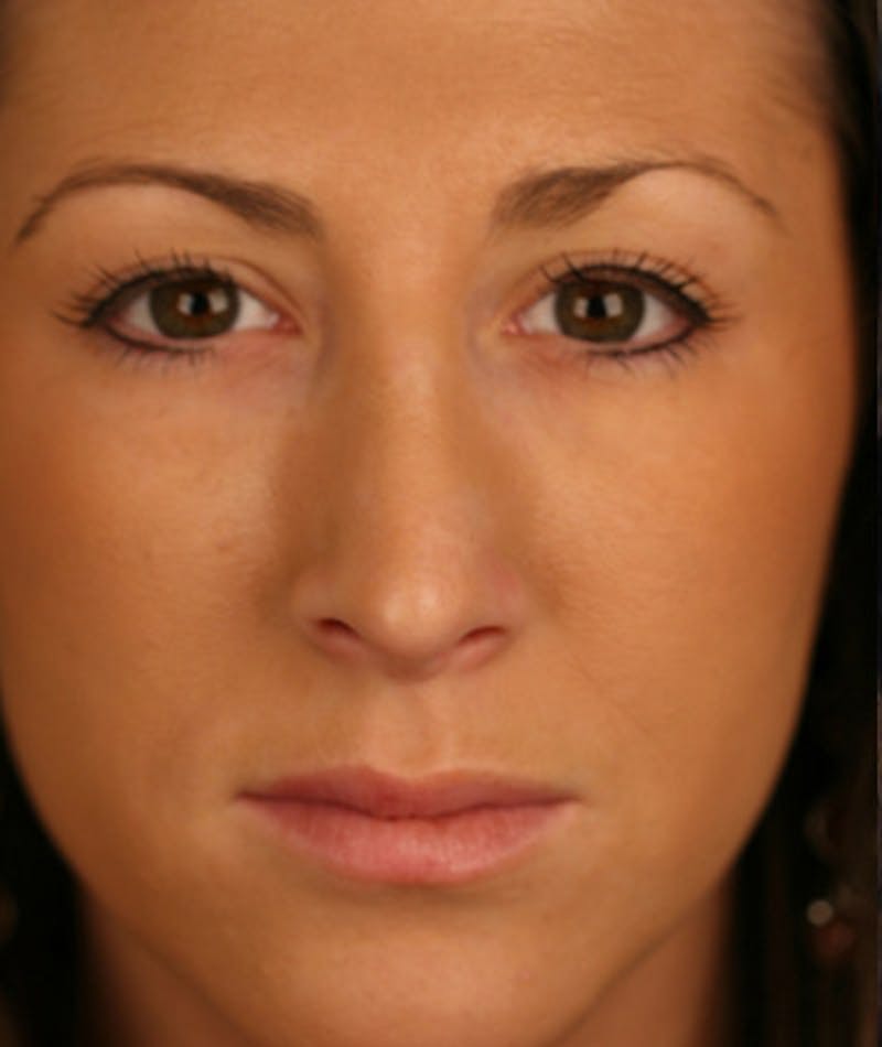 Primary Rhinoplasty Before & After Gallery - Patient 108174333 - Image 4