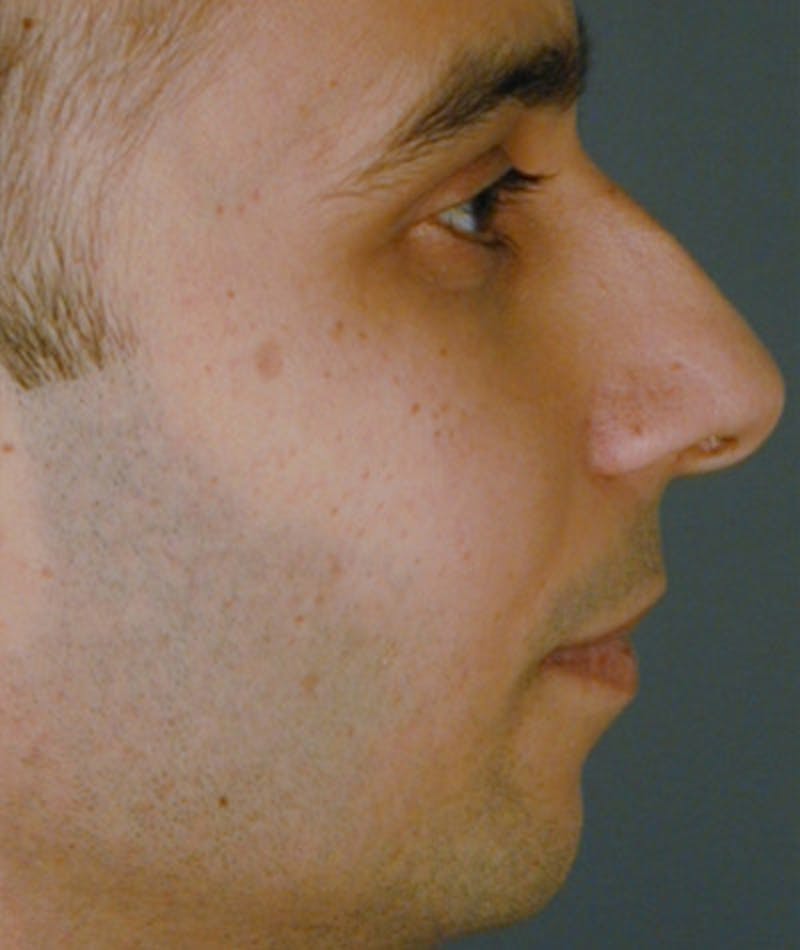 Primary Rhinoplasty Before & After Gallery - Patient 108174334 - Image 1